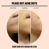 Picture of Peace Out Skincare Acne Healing Dots. 6-hours Fast Acting Anti-Acne Hydrocolloid Pimple Patches with Salicylic Acid to Clear Blemishes Overnight (10 dots)