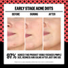 Picture of PEACE OUT Early Stage Acne Dots, Acne-Fighting Pimple Patches, Salicylic Acid Unclogs Pores and Targets Acne Blemishes, (8 Acne Dots)